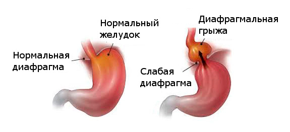 Лапароскопическое удаление диафрагмальных грыж